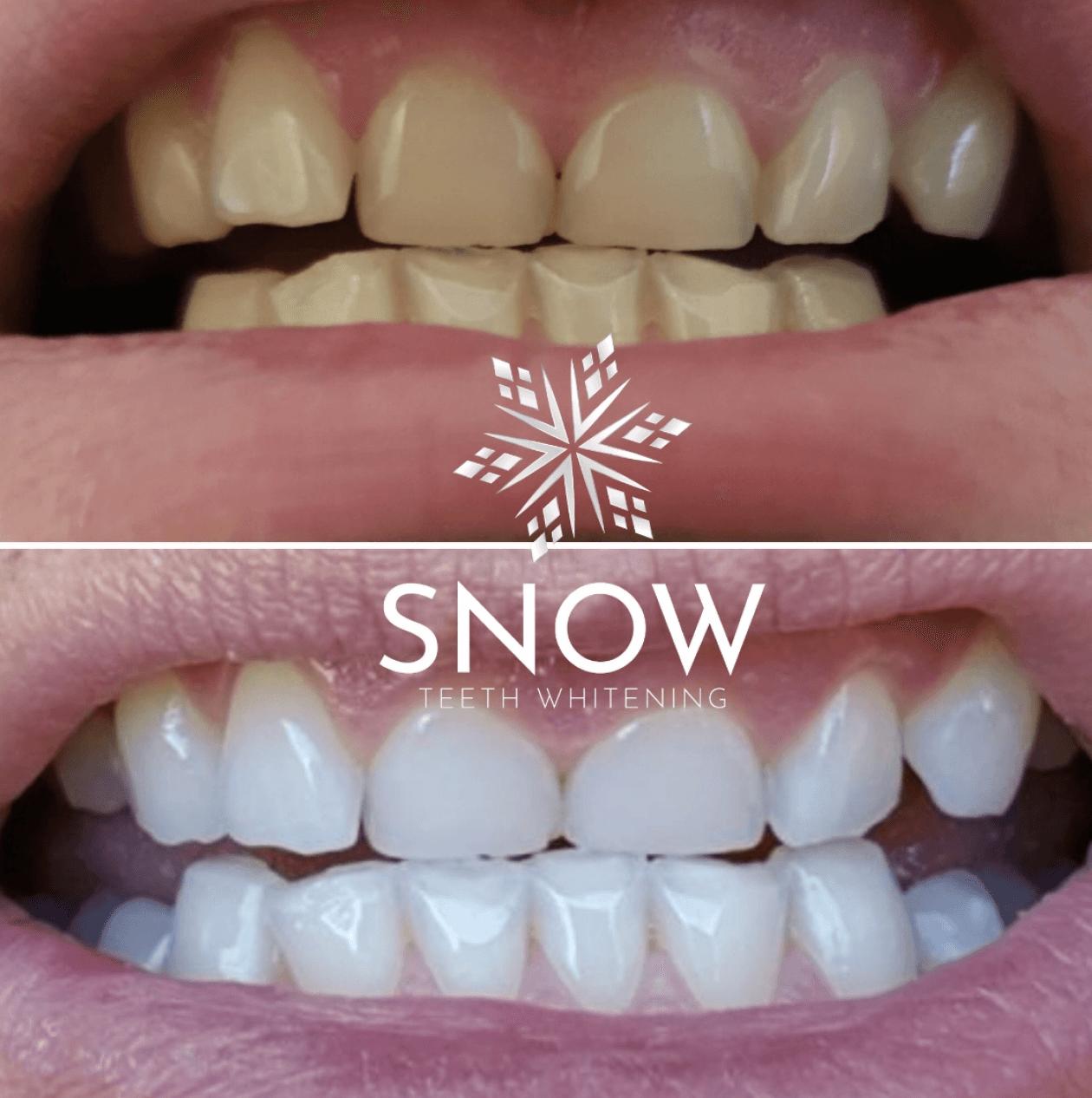 Does Snow Teeth Whitening Work?
